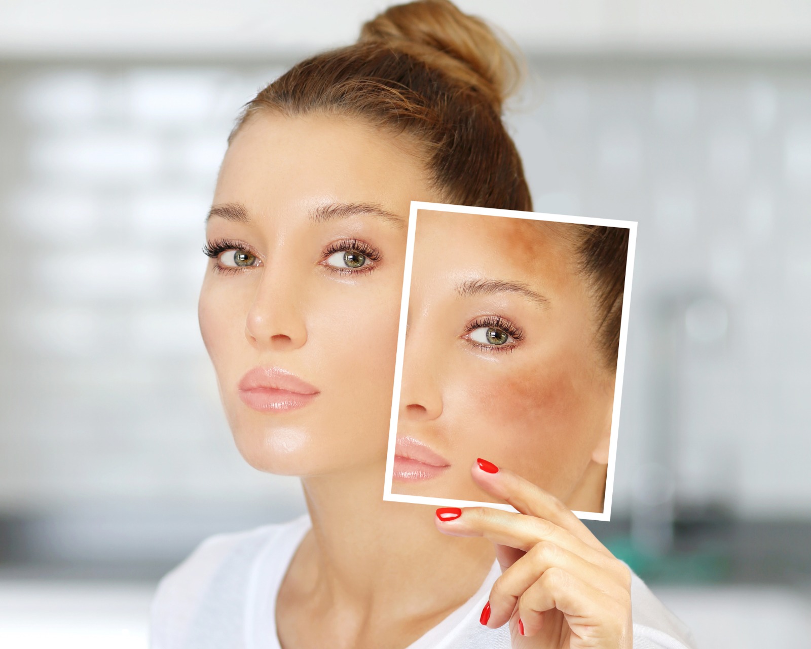 Melasma - 20/08 - Quinta - Feira
